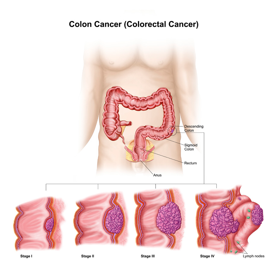 Stages of Colon Cancer Diagram
