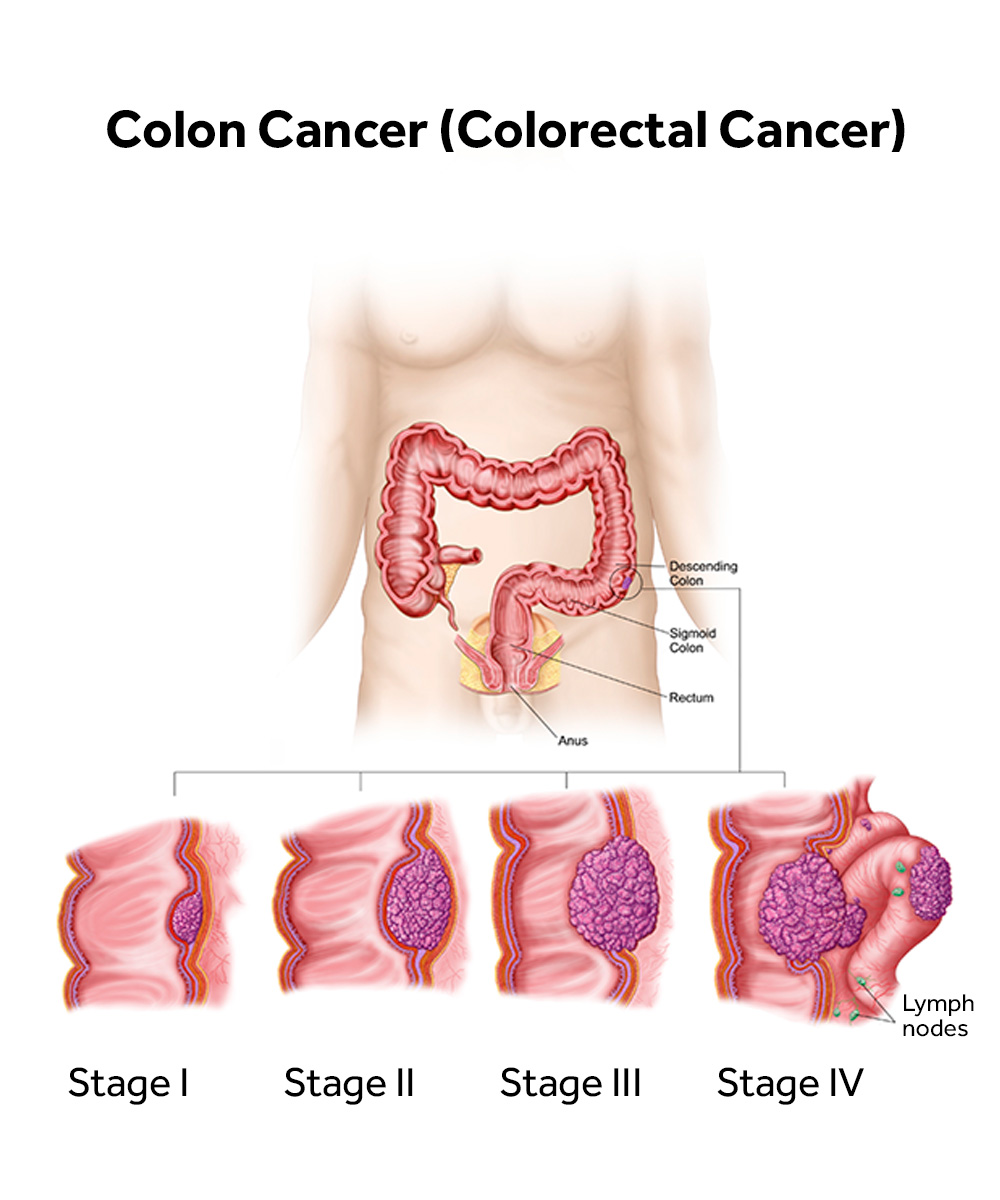 stages of colon cancer